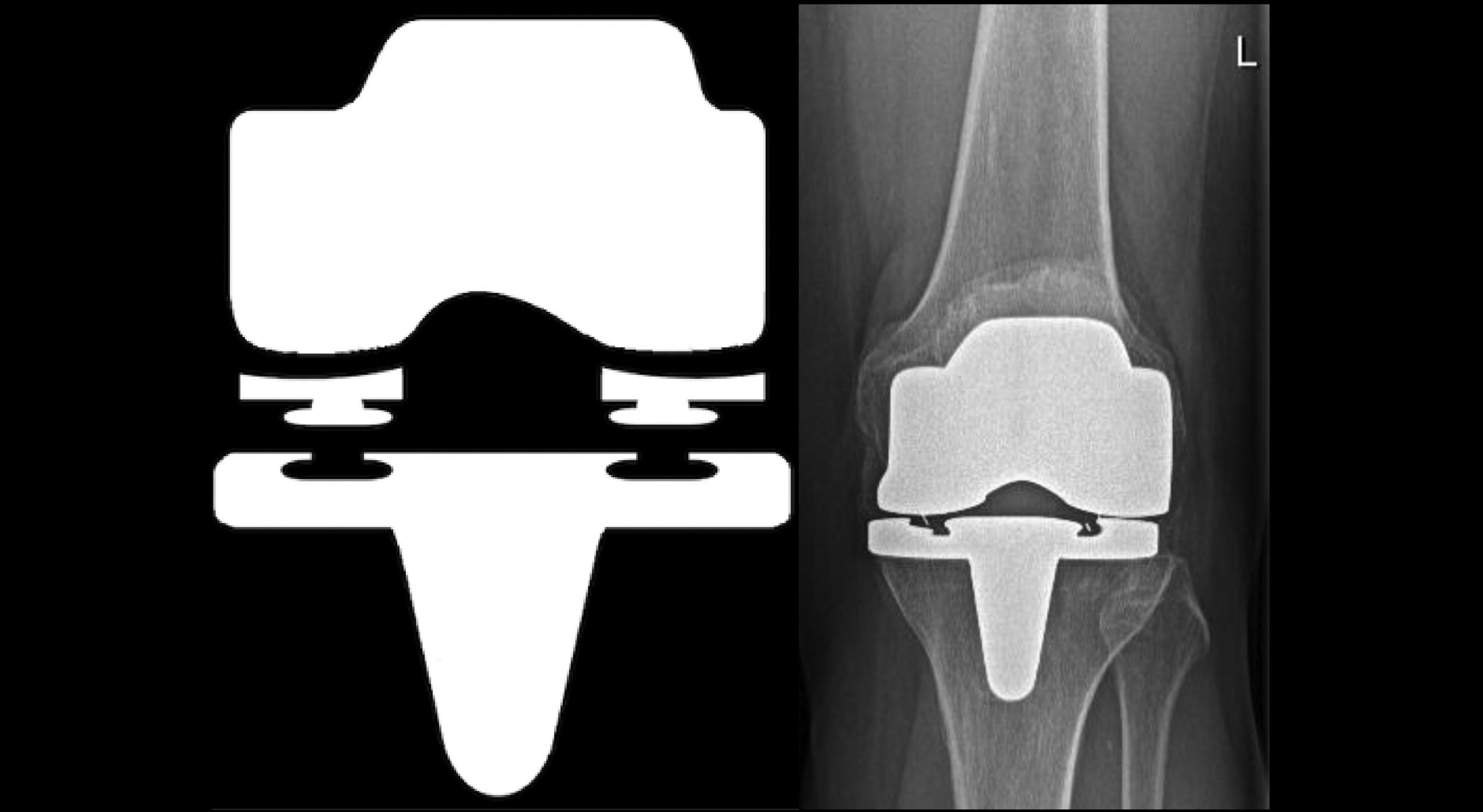 Engineering Innovations Transform Artificial Knee Design