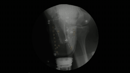 Animation of an Xray showing someone walking with a prosthetic limb.