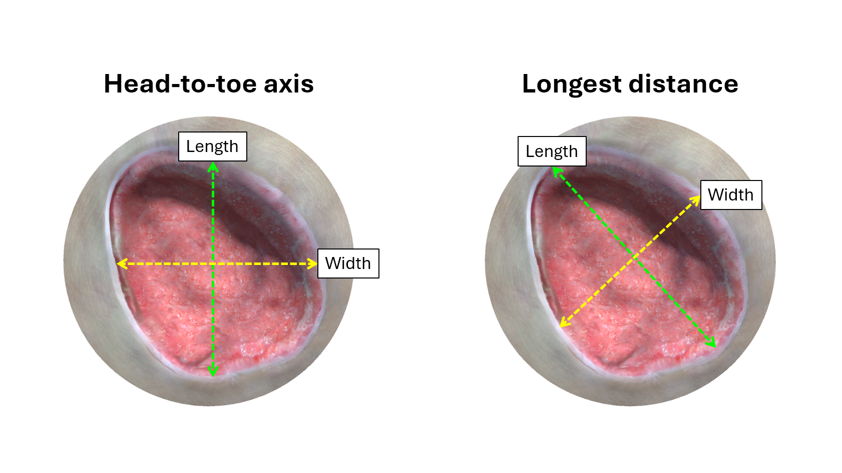 A visualization shows two approaches for calculating the same wound's length and width. 