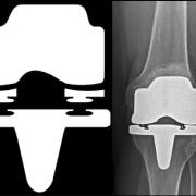 How\u0020Engineering\u0020Helped\u0020Reinvent\u0020the\u0020Artificial\u0020Knee